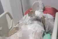 Korban luka bakar (foto: istimewa)