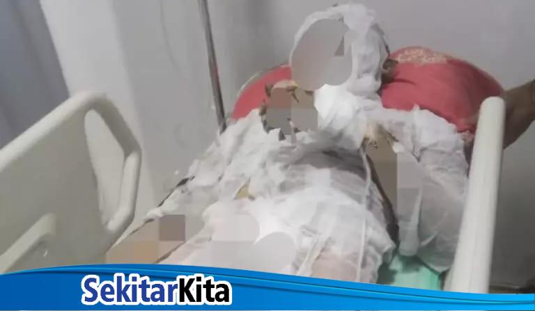 Korban luka bakar (foto: istimewa)